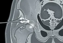 Lesão nos ligamentos do quadril